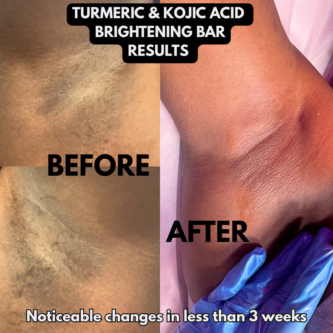 Turmeric & Kojic Acid Brightening Soap