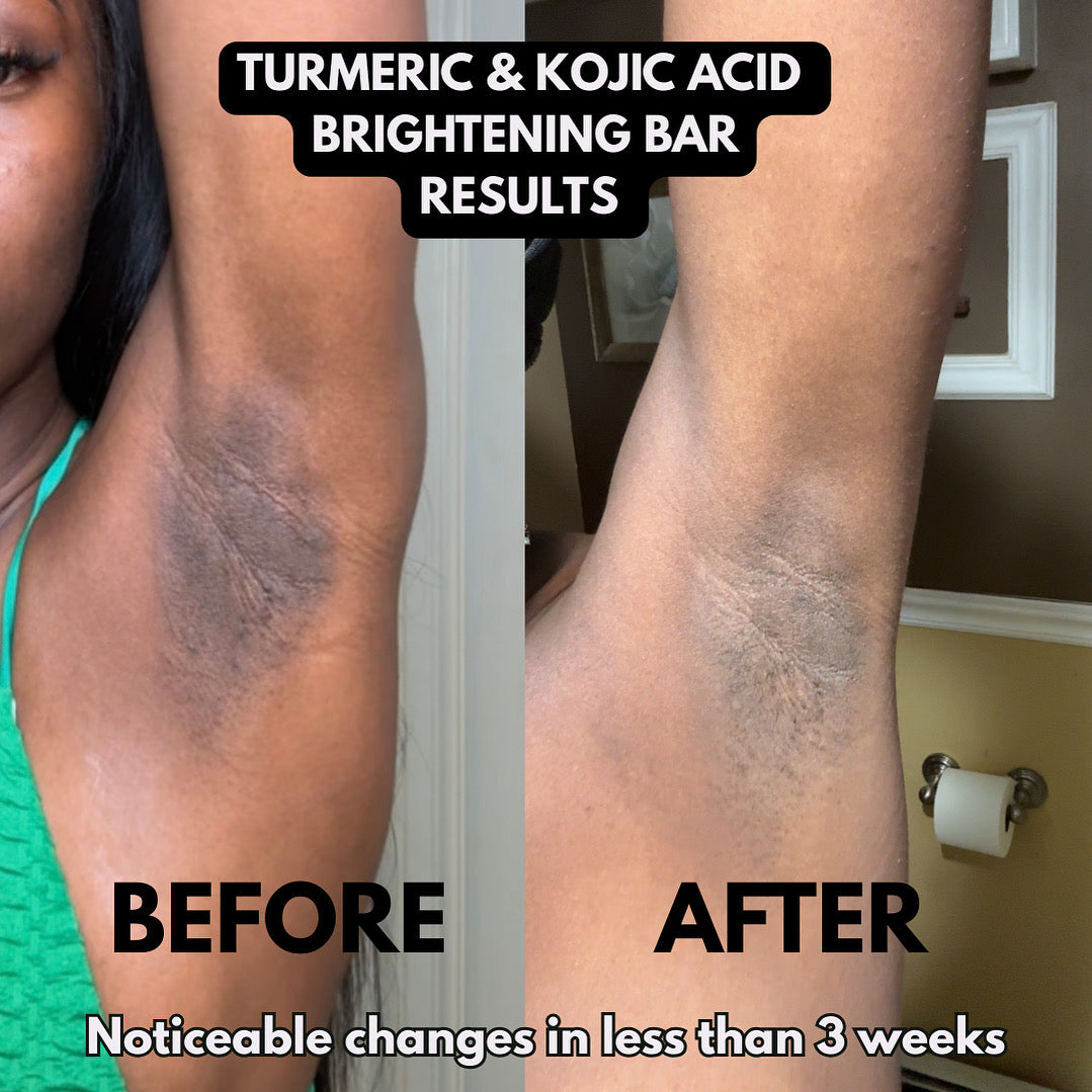 Turmeric & Kojic Acid Brightening Soap